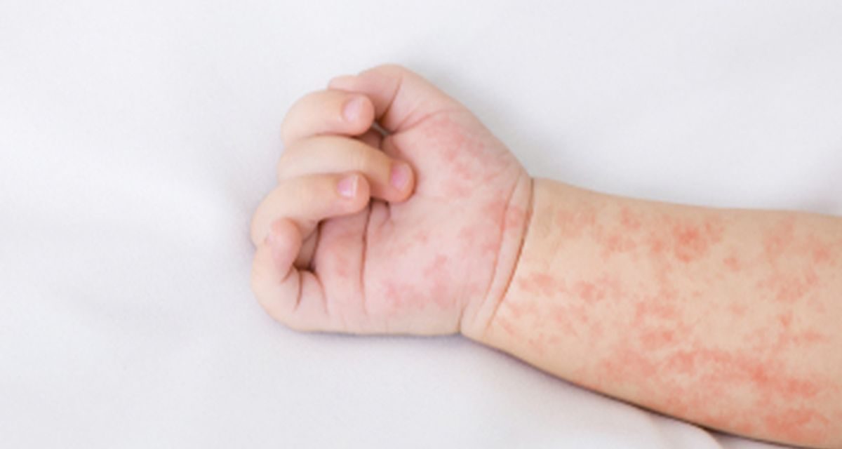 Vaksin Campak Sangat Penting?