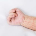 Vaksin Campak Sangat Penting?