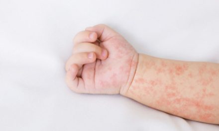 Vaksin Campak Sangat Penting?