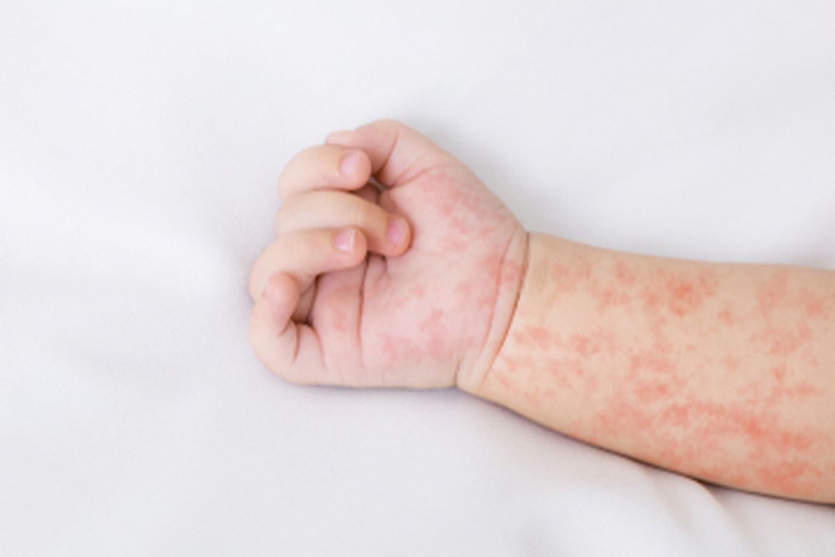 Vaksin Campak Mengapa Sangat Penting?